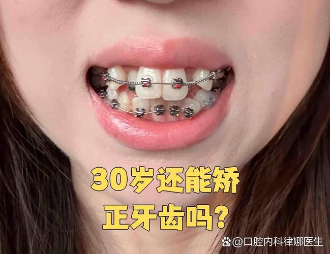 重庆30岁龅牙怎么快速矫正？