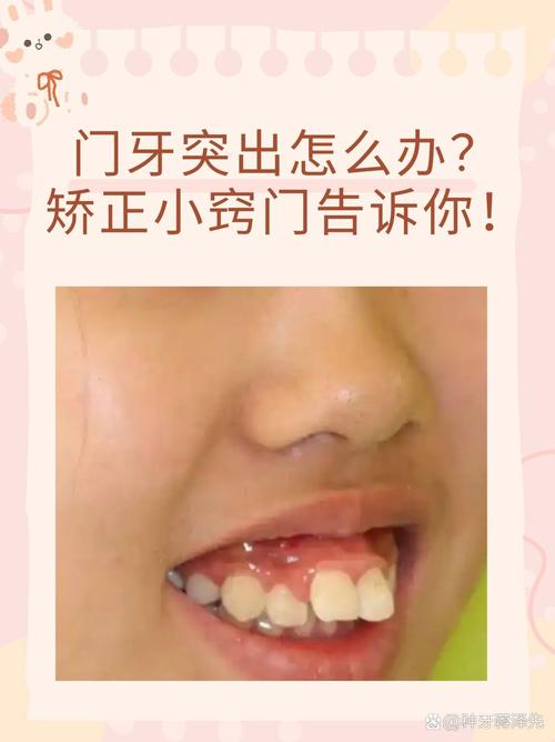 重庆10岁孩子门牙突出，医生揭秘：抓住黄金期，这个最快