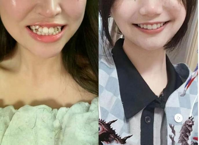 重庆36岁还能矫正牙齿吗 成人正畸的真相与风险