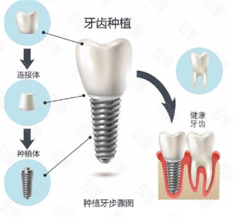 重庆九江威高种植牙多少钱一颗2026最新价格