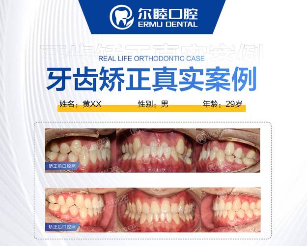 重庆深圳南山做MRC矫正哪家医院靠谱？