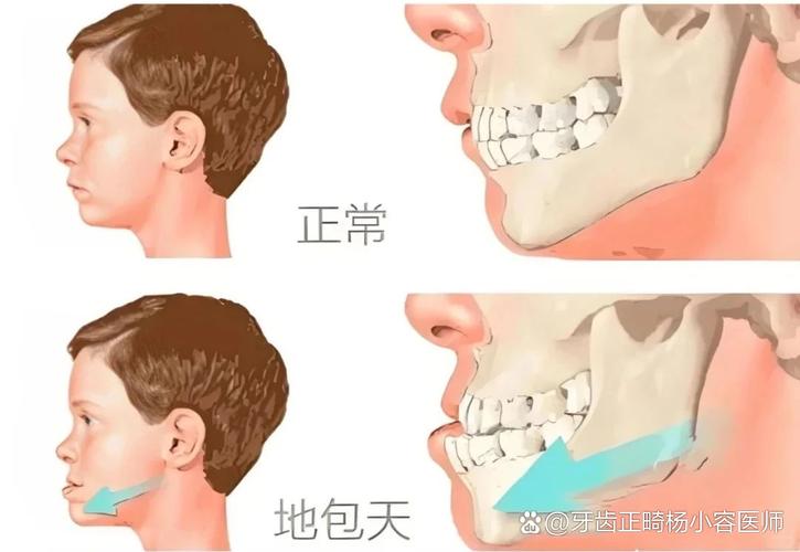 重庆12岁小孩能做牙齿矫正吗？别等换完牙才后悔