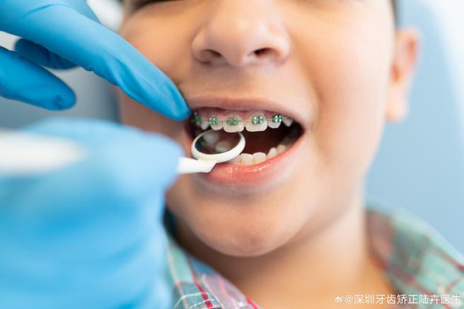 重庆8岁孩子门牙龅牙矫正方法 儿童早期干预怎么做