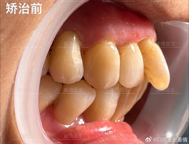 重庆60岁还能做牙齿矫正吗