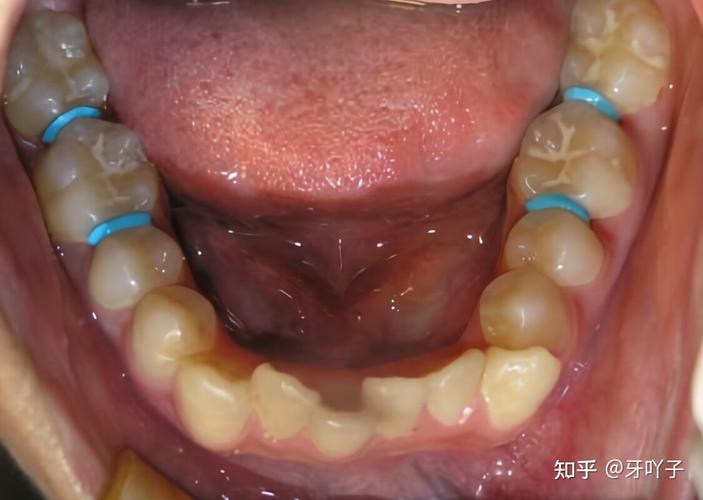 重庆玉林牙齿矫正效果怎么样？看完这篇就心里有数了