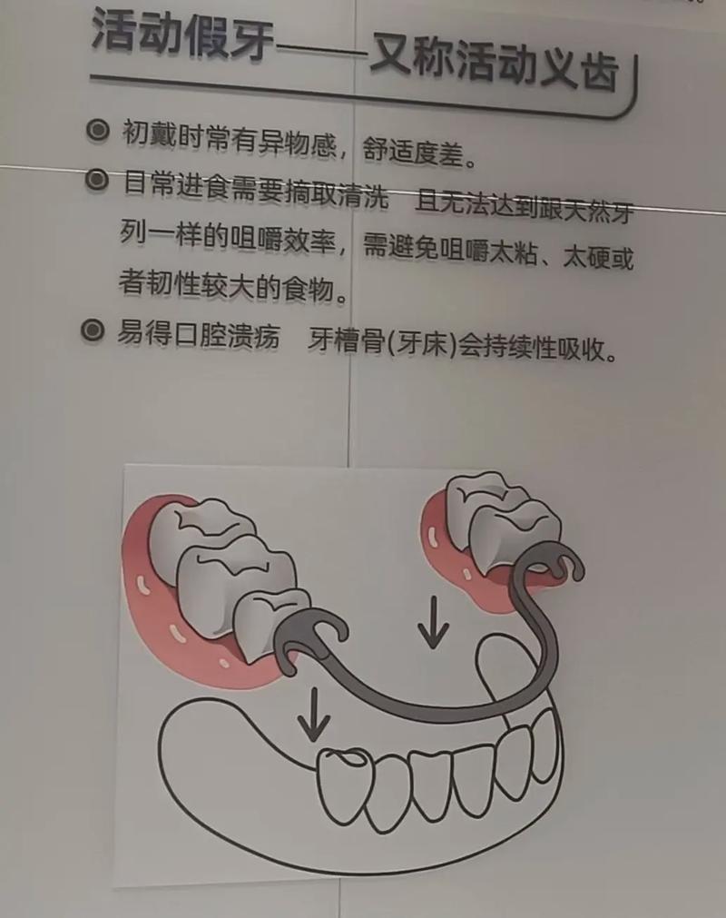 重庆活动假牙固定假牙种植牙哪个好 牙医一次说清别再被忽悠