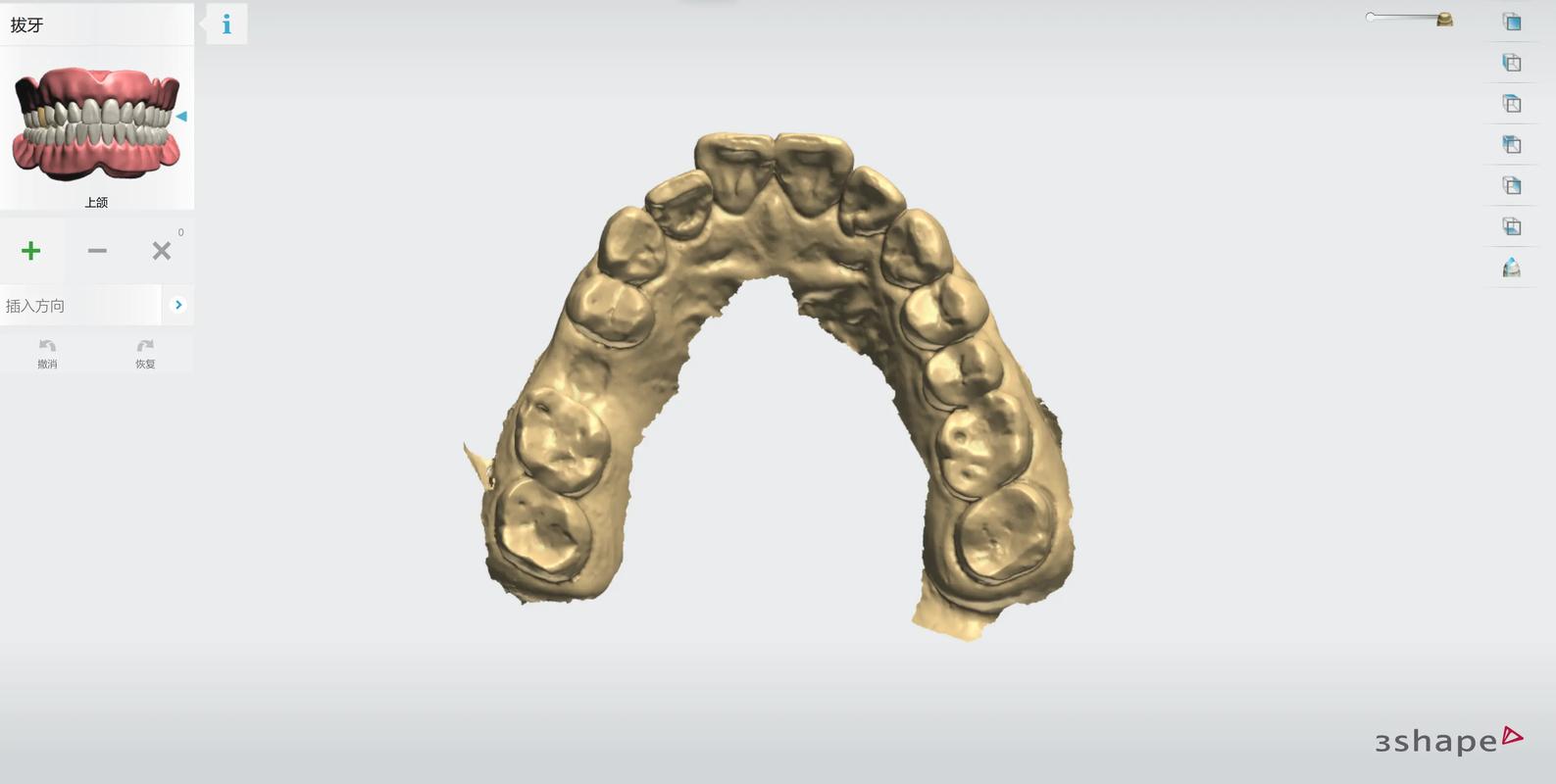 重庆3D导板数字化种植牙：告别传统盲种，种牙更精准更安心