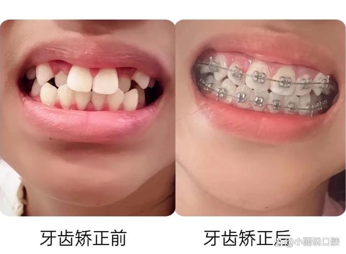 重庆15岁牙齿不齐怎么办 专家说三种矫正方式哪种最适合你