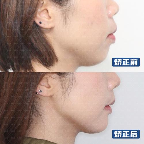 重庆矫正牙齿能改善下巴后缩吗