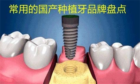 重庆深圳百康特种植牙多少钱？最新优惠看这里