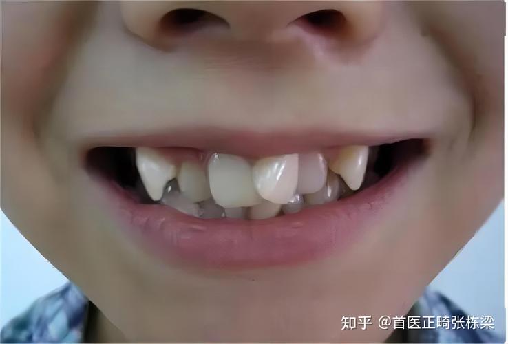 重庆深圳儿童地包天最佳矫正年龄是多少？别等换牙误了大事