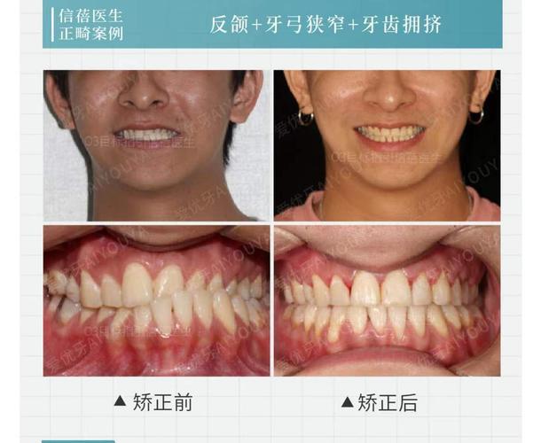 重庆深圳中学生牙齿矫正优惠活动真的靠谱吗？