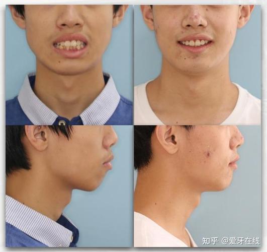 重庆呼和浩特牙齿矫正靠不靠谱？效果真实揭秘