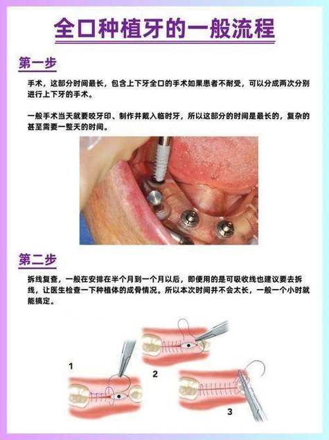重庆沈阳种植牙2026价格：单颗3000-5200元是真的吗