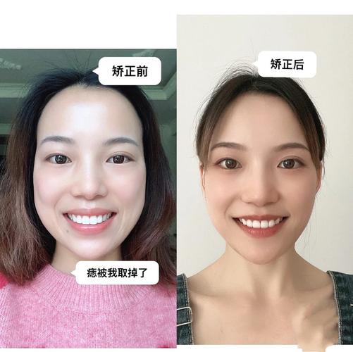 重庆成年人牙齿矫正还来得及吗