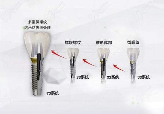 重庆唐山韩系奥齿泰种植牙2026最新费用一览