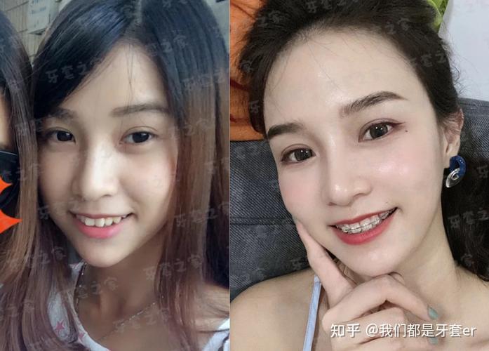 重庆43岁矫正深覆合牙齿要多少钱？从检查到摘牙套费用全掰扯清楚