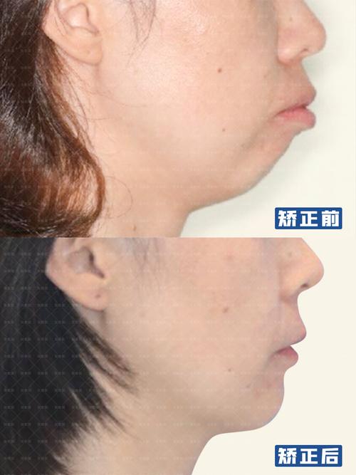 重庆矫正牙齿能改善下巴后缩吗？3个关键问题正畸医生一次说清