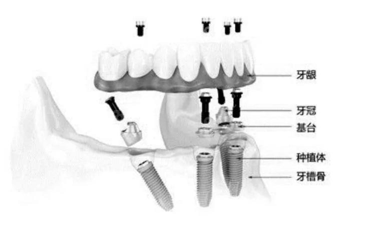 重庆半口种牙费用不固定 一颗大概多少钱