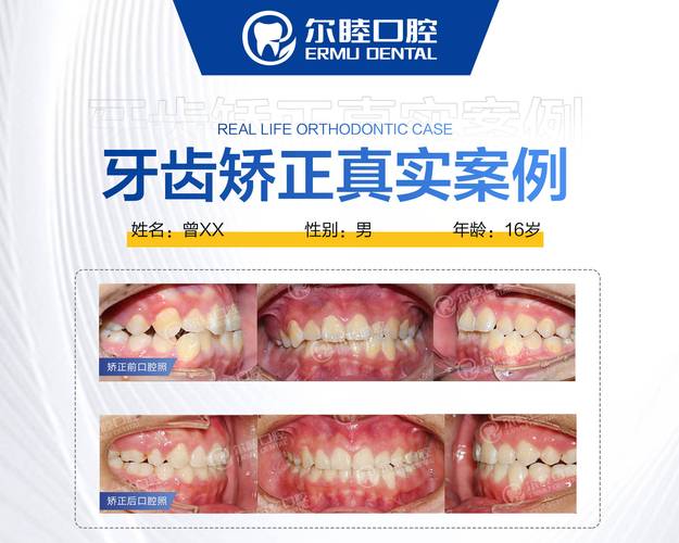 重庆深圳龙华牙齿不齐钢丝矫正费用大概多少？