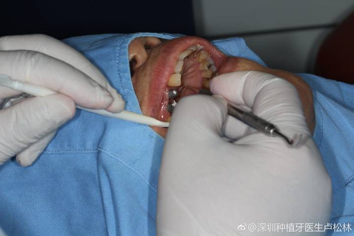 重庆80岁还能种牙吗？医生说只要满足这个条件就能做