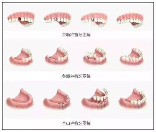 重庆半口种植牙全过程要多久？疼不疼？一步步讲清楚