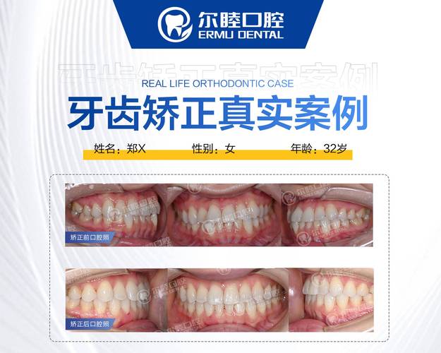 重庆成人矫正牙齿咬合疼不疼？效果和费用全解析