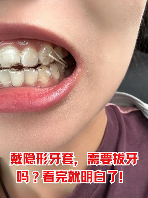隐形牙齿矫正带怎么戴_带隐形矫正牙齿_隐形矫正佩戴