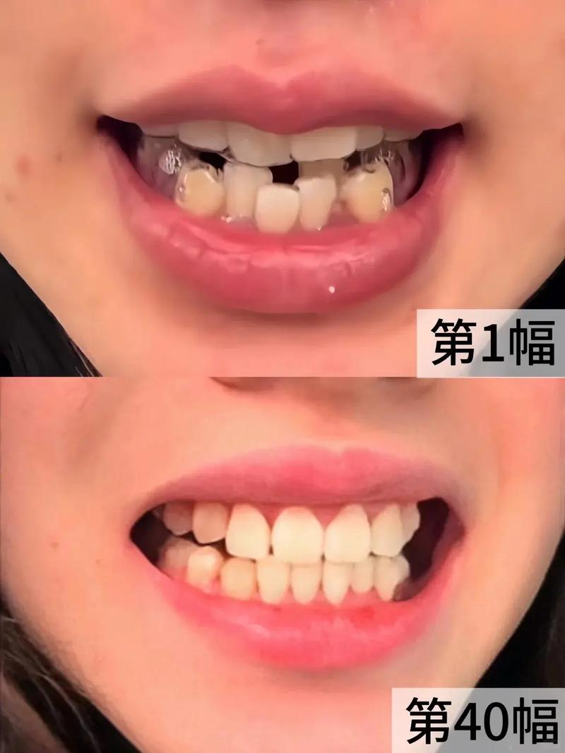 隐形矫正佩戴_隐形牙齿矫正带怎么戴_带隐形矫正牙齿