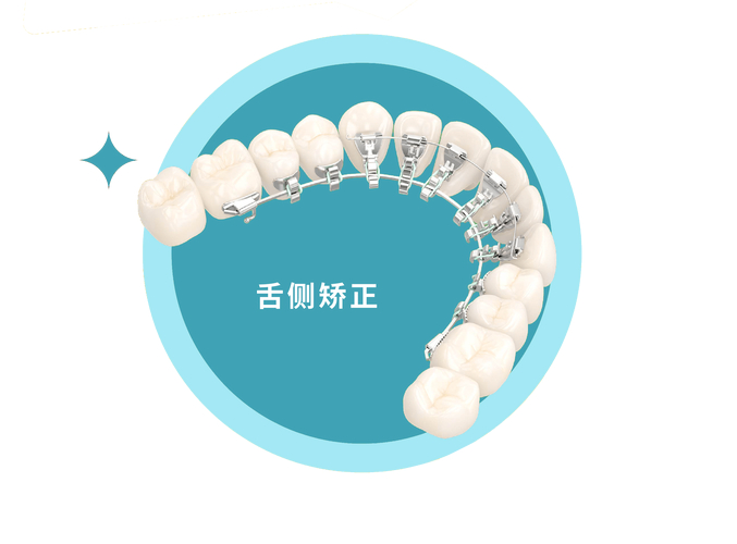 重庆成年人牙齿舌侧正畸到底值不值？看完这几点就懂了