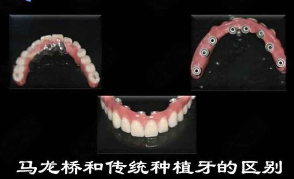 附近牙科种牙_附近种牙_附近哪里有种植牙诊所