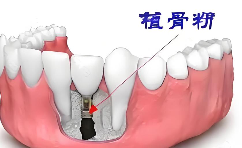 重庆5000元的种植牙靠谱吗