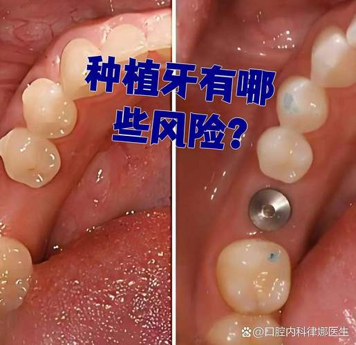 重庆全口种植牙的风险和后遗症有哪些