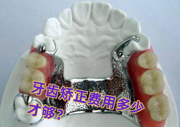 重庆长沙矫正牙齿费用一览：从几千到几万差在哪