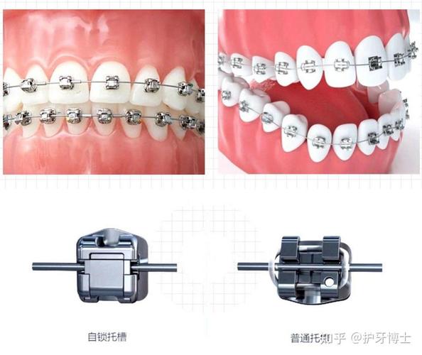 重庆暴门牙矫正费用一览