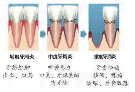 重庆深圳牙周炎治疗到底要花多少钱？2026最新费用解析
