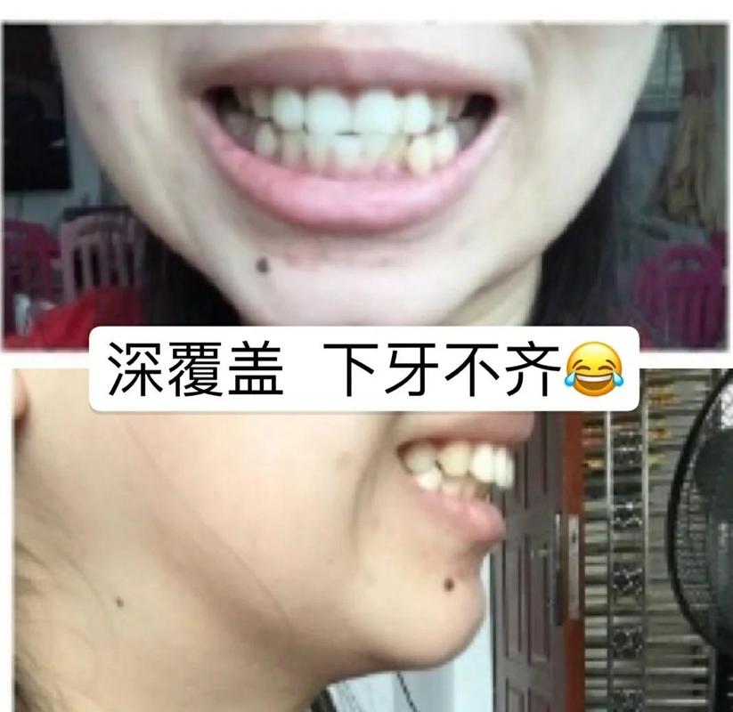 重庆39岁牙齿矫正还有用吗 真实效果看这里
