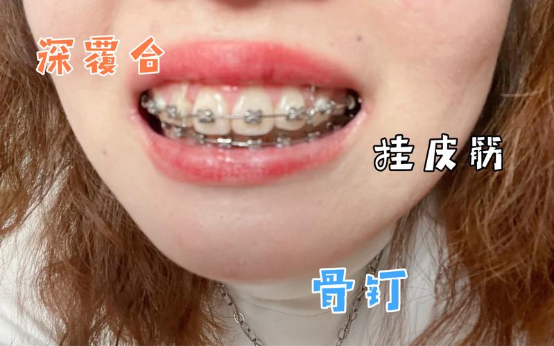 重庆深圳深覆合正畸去哪家好？牙科推荐避坑指南